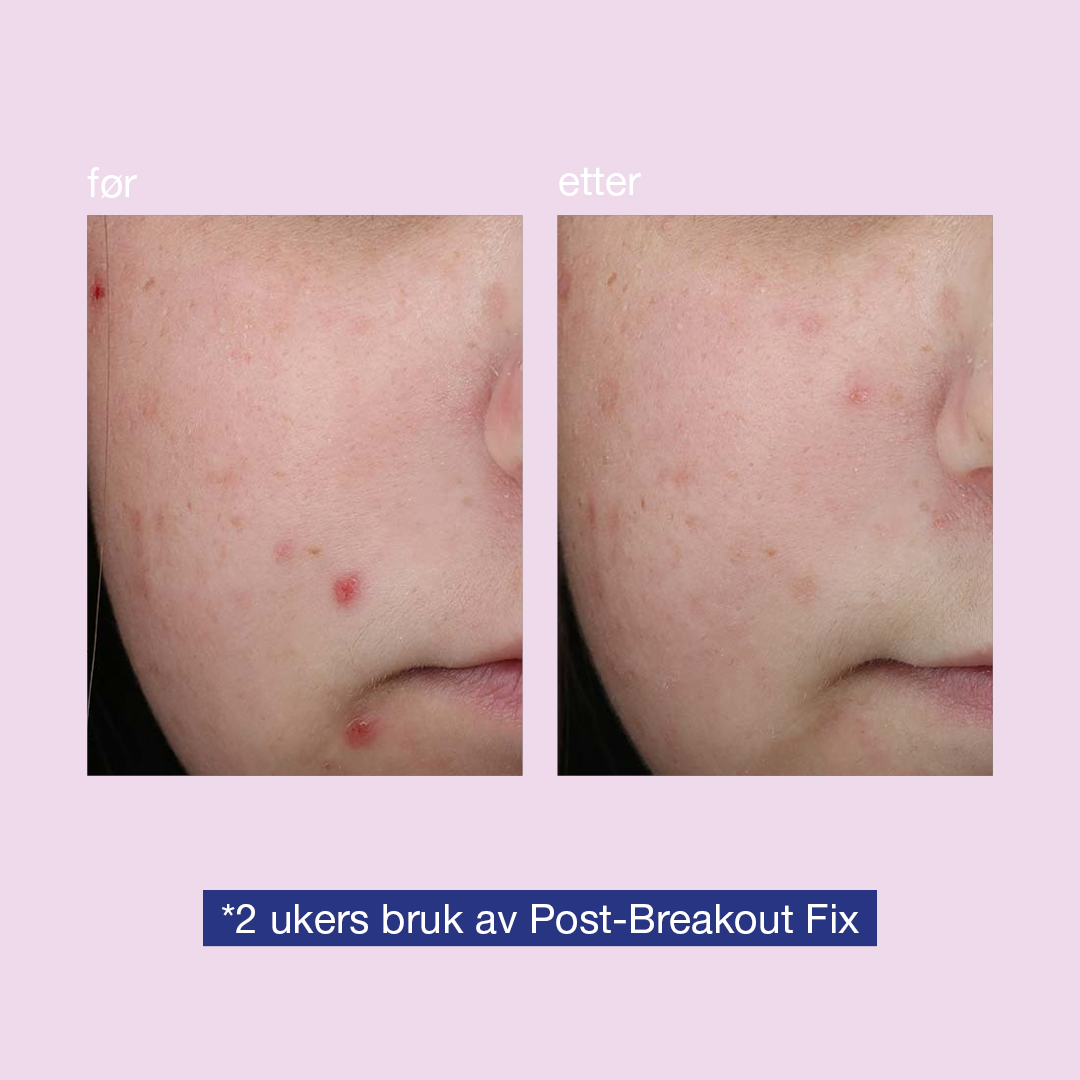 clear start post breakout fix før og etter 2 ukers bruk