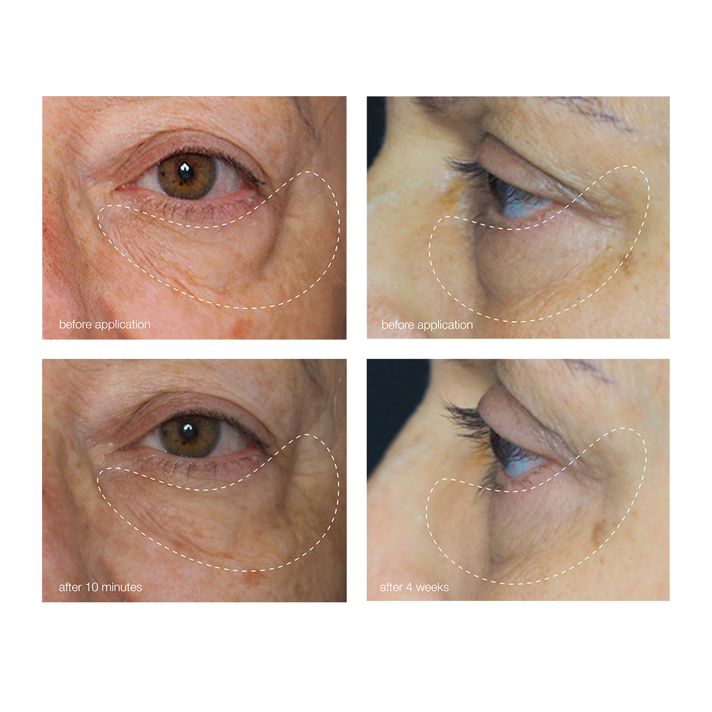 dermalogica awaken peptide eye gel før og etter