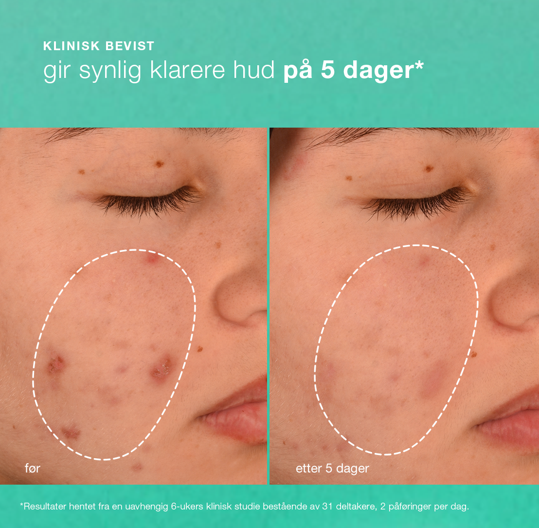 acne biotic moisturizer