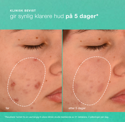 acne biotic moisturizer