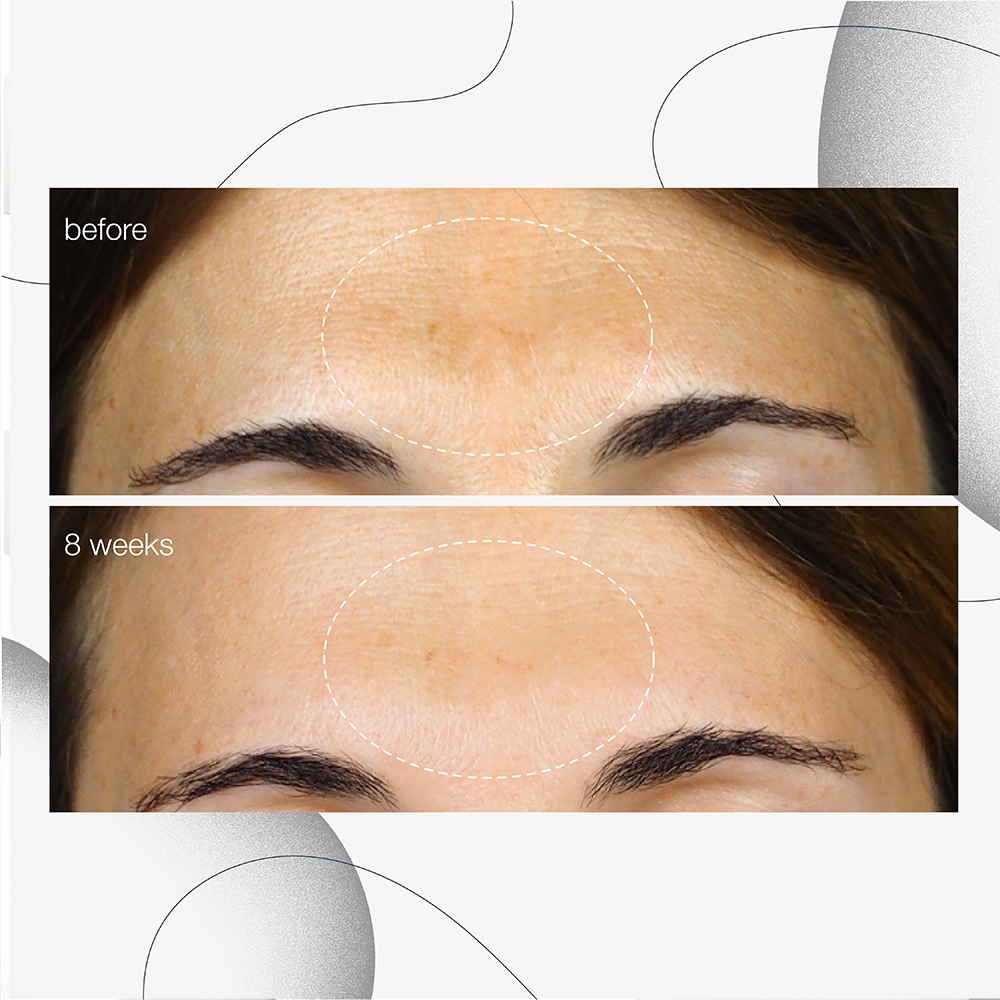 dermalogica powerbright dark spot serum før og etter 8 ukers bruk